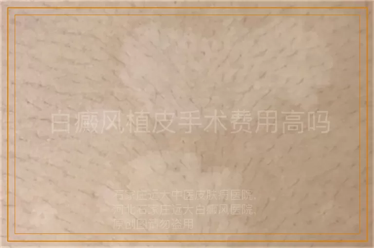 白癜风植皮手术费用高吗
