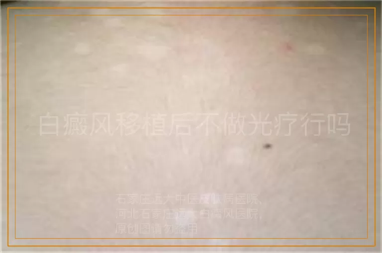 白癜风移植后不做光疗行吗