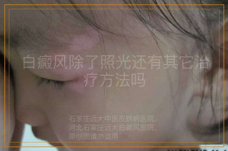 白癜风除了照光还有其它治疗方法吗