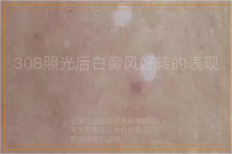 308照光后白癜风好转的表现