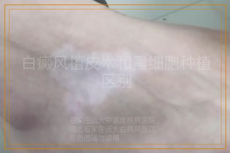 白癜风植皮术和黑细胞种植区别