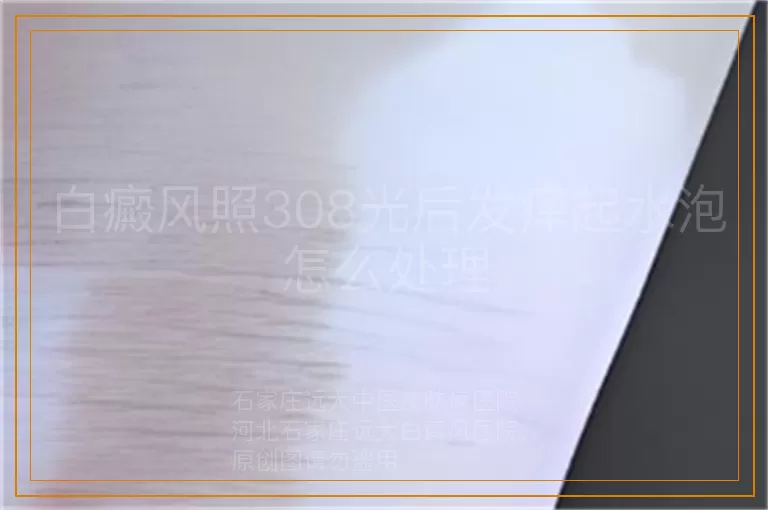 白癜风照308光后发痒起水泡怎么处理
