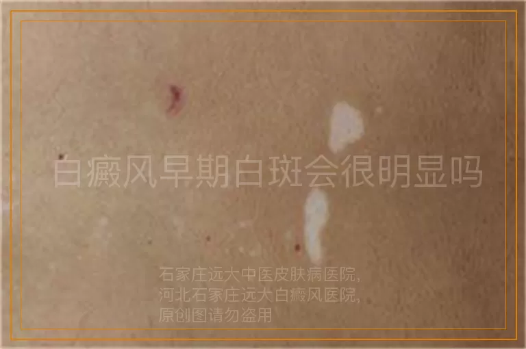 白癜风早期白斑会很明显吗