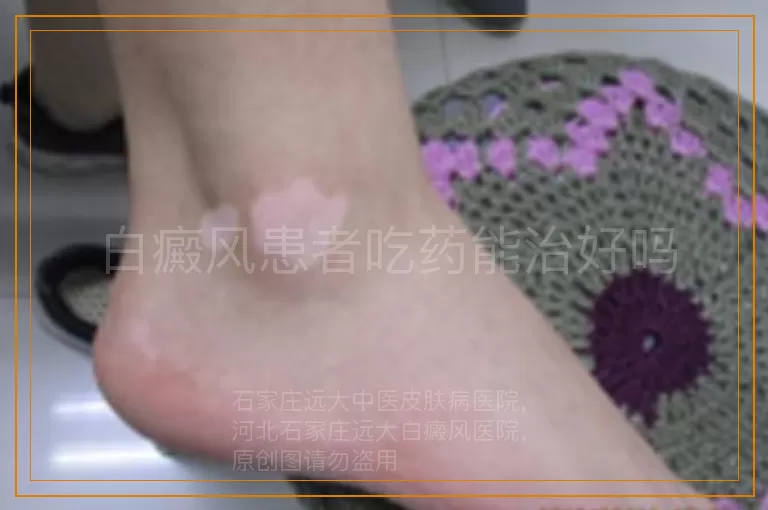 白癜风患者吃药能治好吗