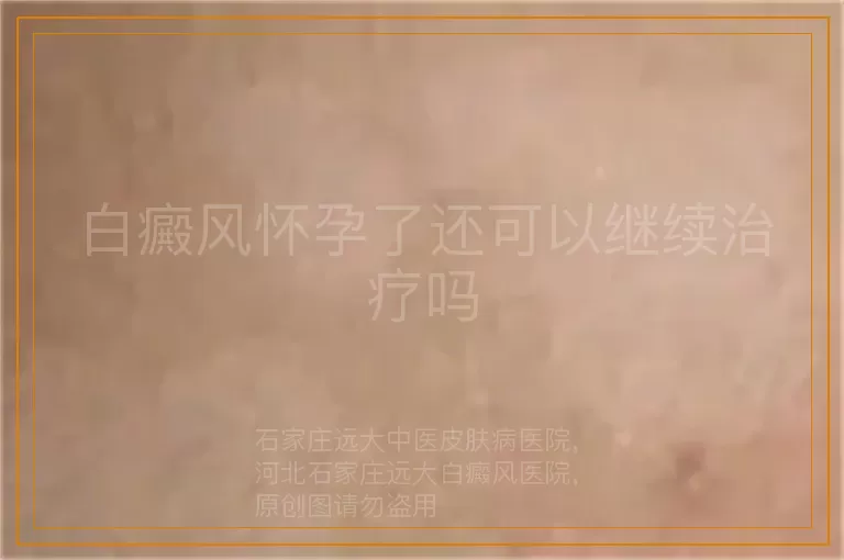 白癜风怀孕了还可以继续治疗吗