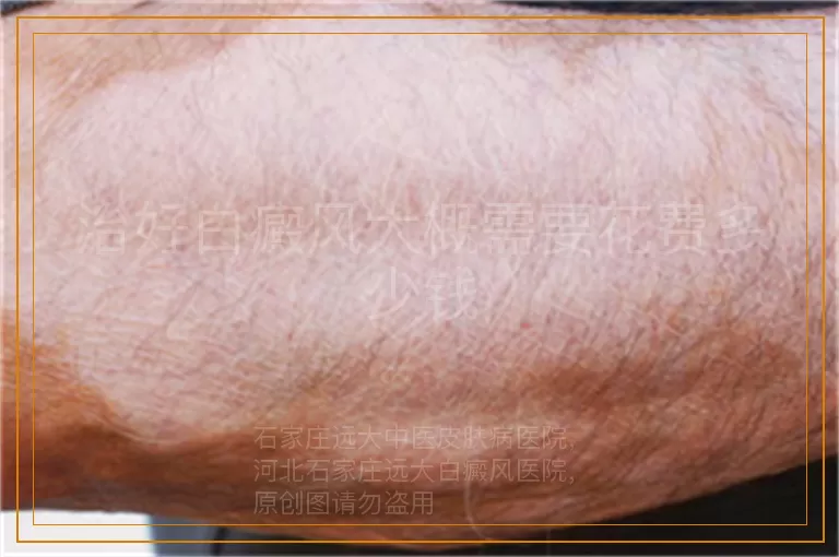 治好白癜风大概需要花费多少钱