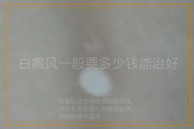 白癜风一般要多少钱能治好