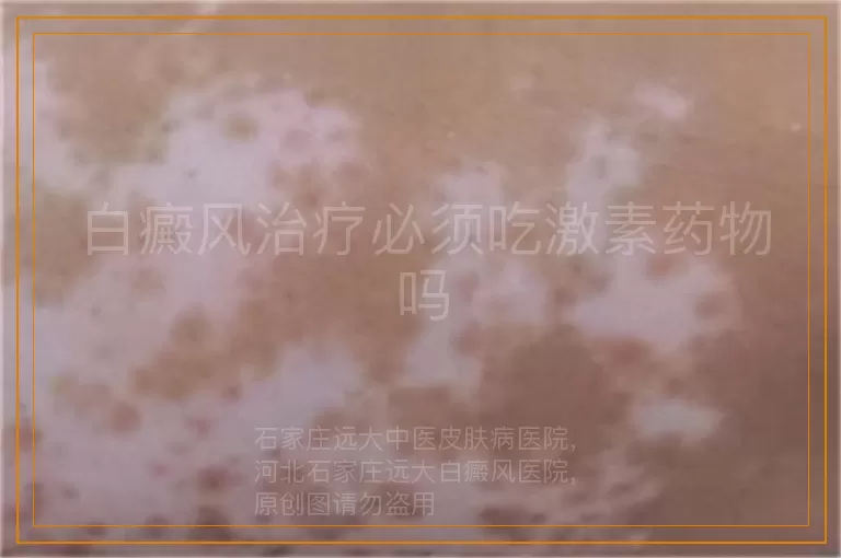 白癜风治疗必须吃激素药物吗