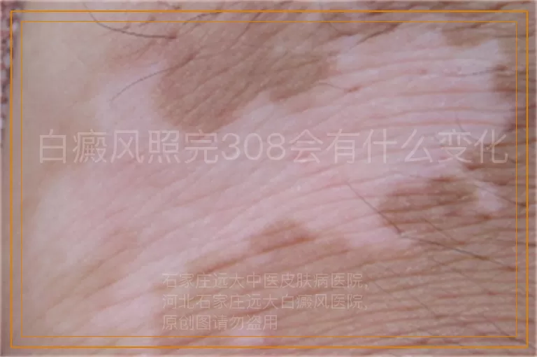 白癜风照完308会有什么变化