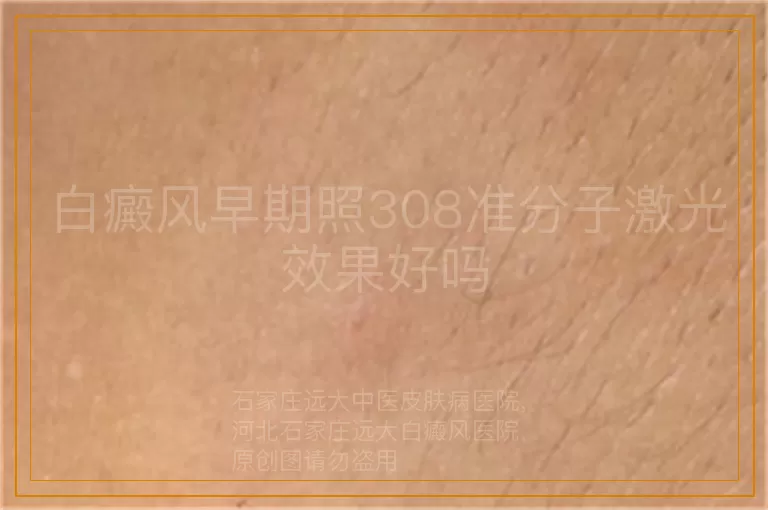 白癜风早期照308准分子激光效果好吗