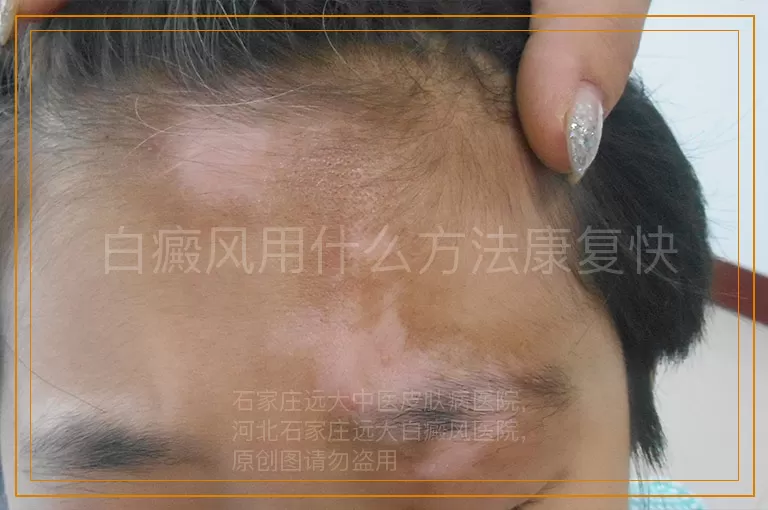 白癜风用什么方法康复快
