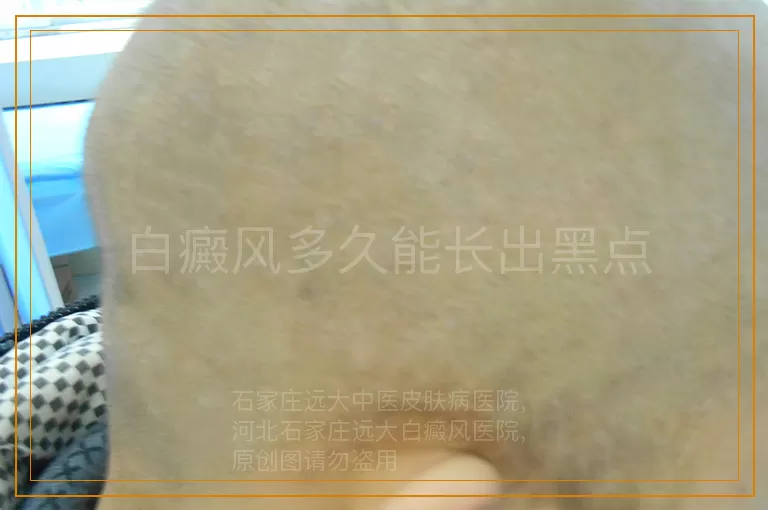 白癜风多久能长出黑点