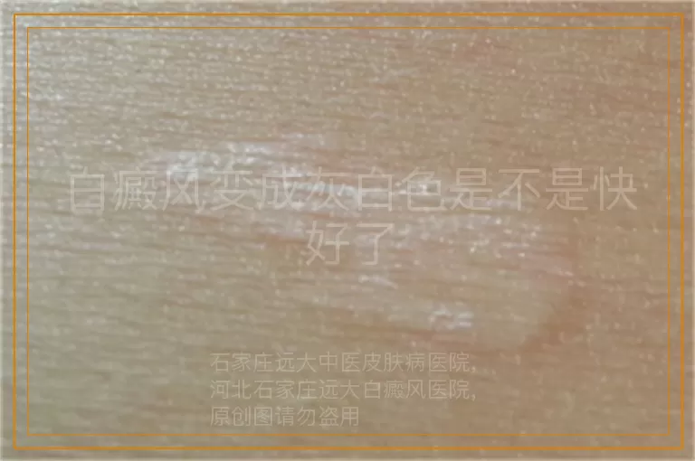 白癜风变成灰白色是不是快好了