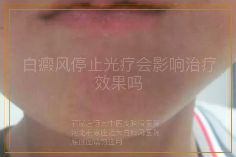 白癜风停止光疗会影响治疗效果吗
