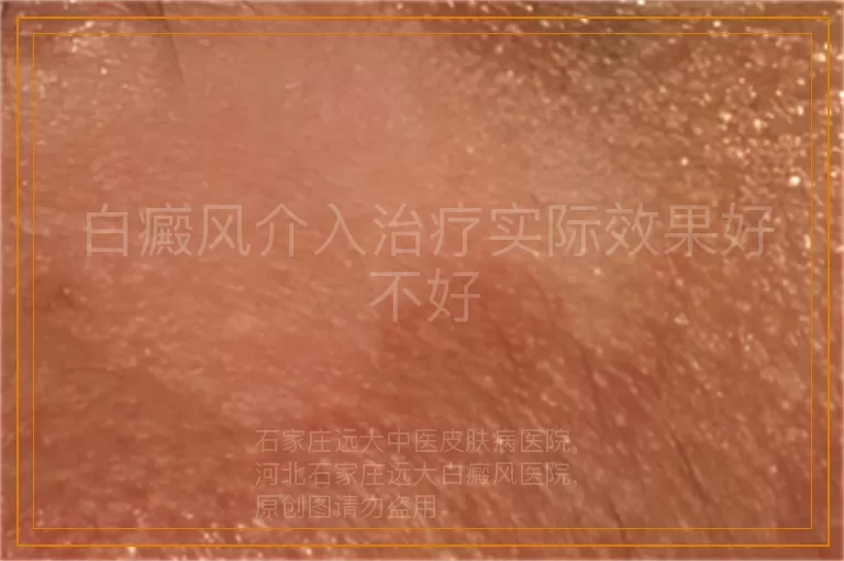 白癜风介入治疗实际效果好不好