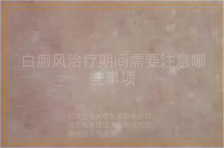 白癜风治疗期间需要注意哪些事项