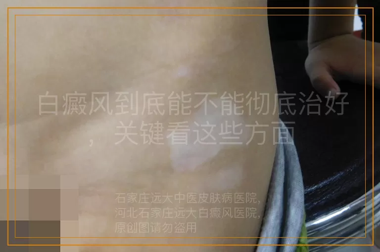 白癜风到底能不能彻底治好，关键看这些方面