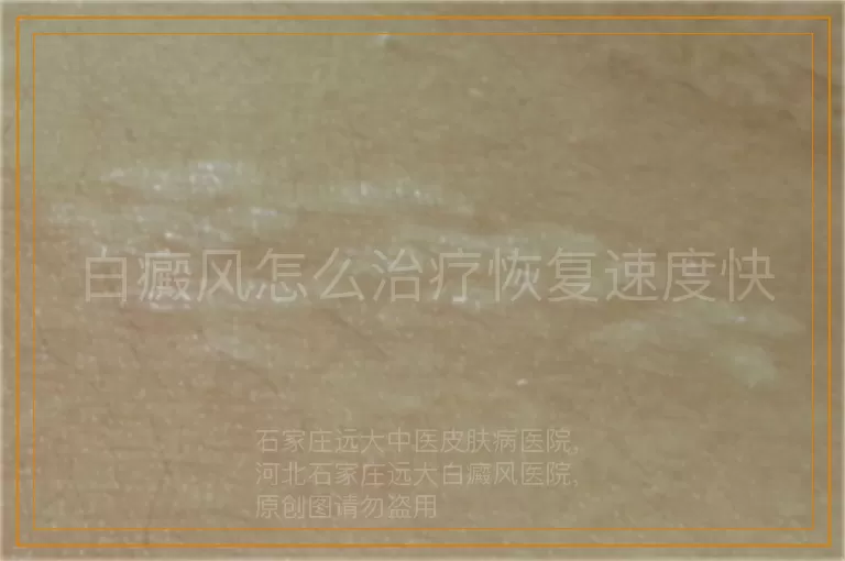 白癜风怎么治疗恢复速度快
