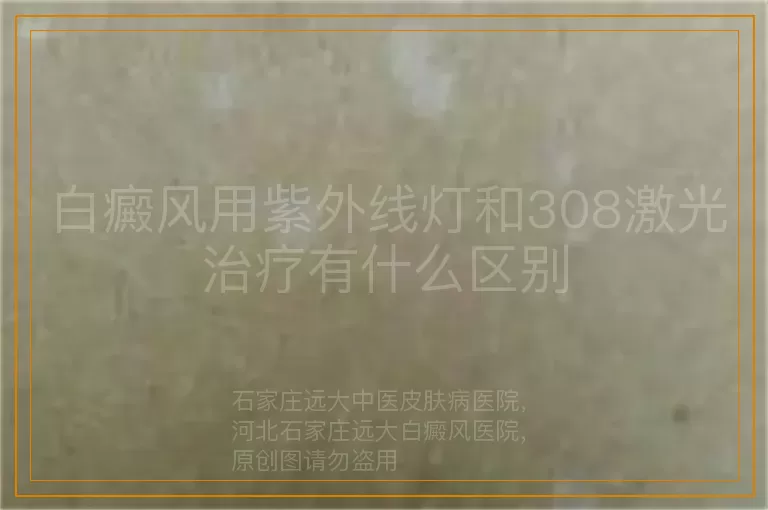 白癜风用紫外线灯和308激光治疗有什么区别