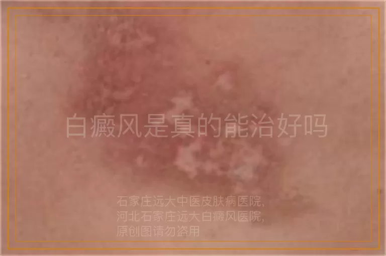 白癜风是真的能治好吗