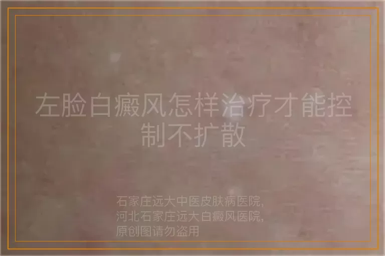 左脸白癜风怎样治疗才能控制不扩散