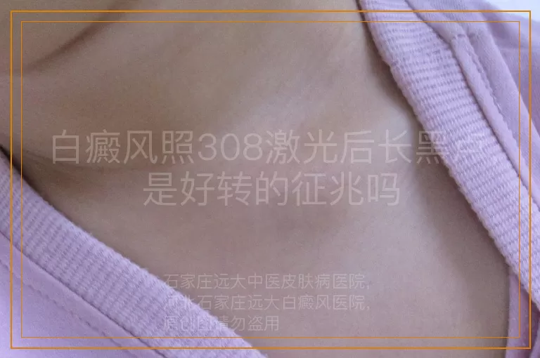白癜风照308激光后长黑点，是好转的征兆吗