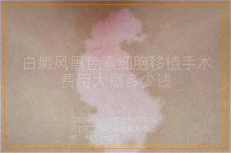 白癜风黑色素细胞移植手术费用大概多少钱