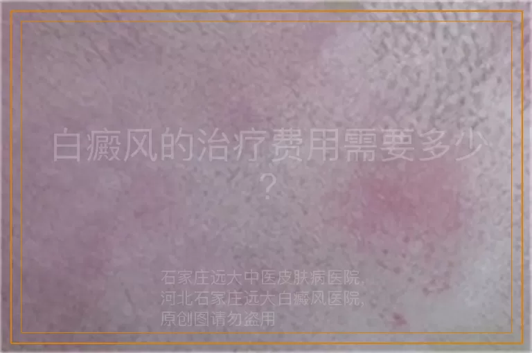 白癜风的治疗费用需要多少?