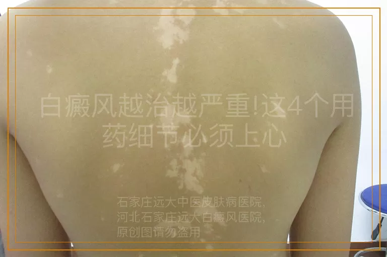 白癜风越治越严重!这4个用药细节必须上心