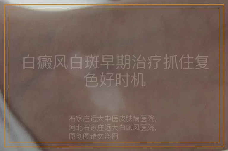 白癜风白斑早期治疗抓住复色好时机