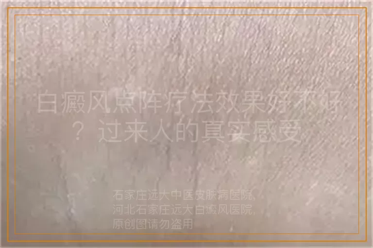 白癜风点阵疗法效果好不好？过来人的真实感受