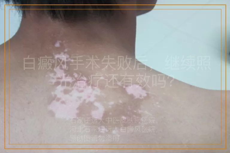 白癜风手术失败后，继续照光治疗还有效吗？