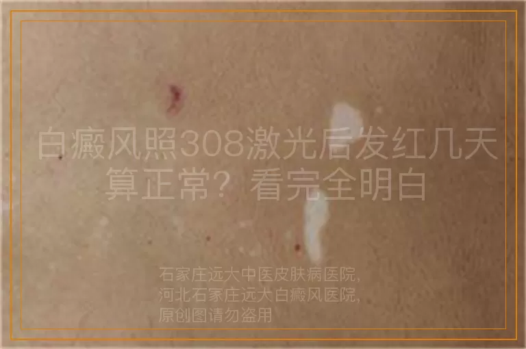 白癜风照308激光后发红几天算正常？看完全明白
