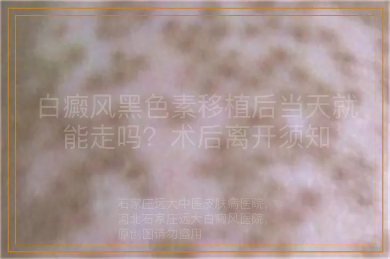 白癜风黑色素移植后当天就能走吗？术后离开须知