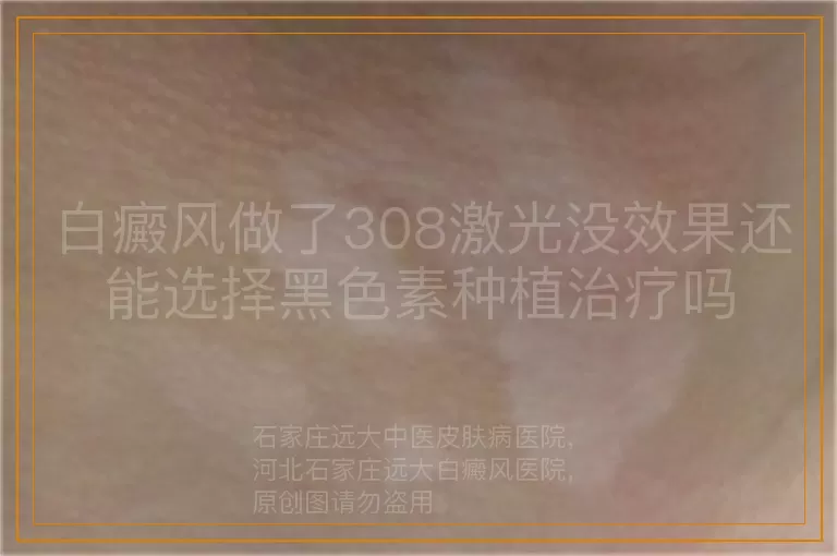 白癜风做了308激光没效果还能选择黑色素种植治疗吗