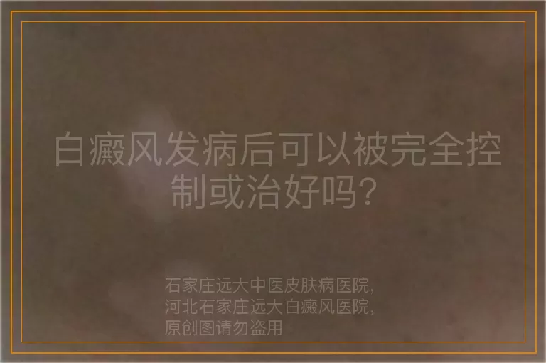 白癜风发病后可以被完全控制或治好吗？