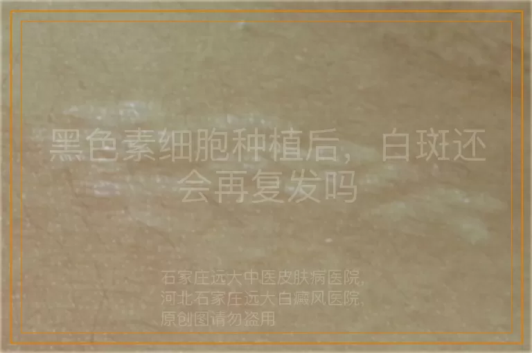 黑色素细胞种植后，白斑还会再复发吗
