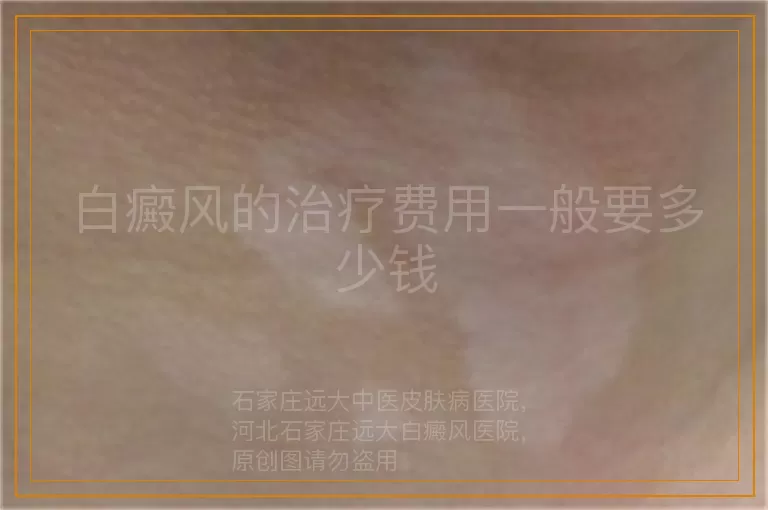 白癜风的治疗费用一般要多少钱