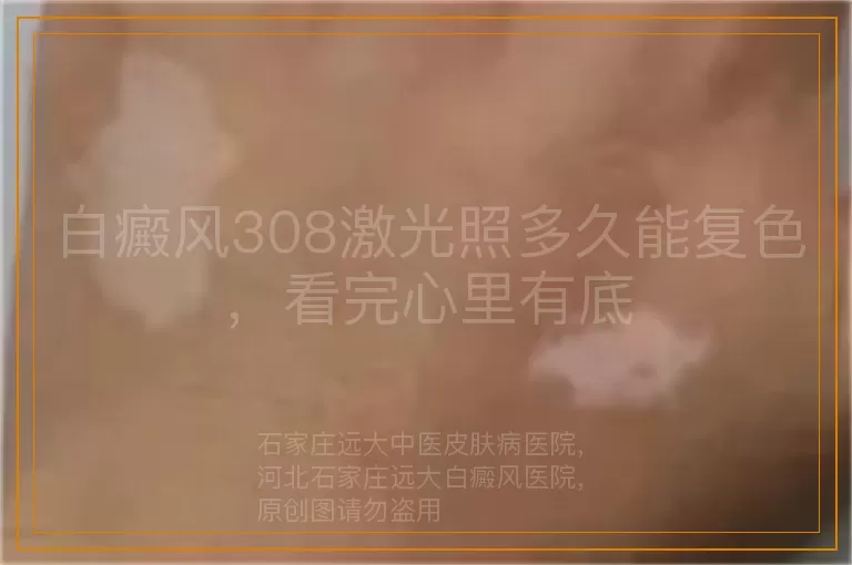 白癜风308激光照多久能复色，看完心里有底
