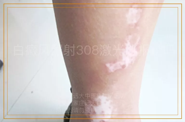 白癜风照射308激光能报销吗