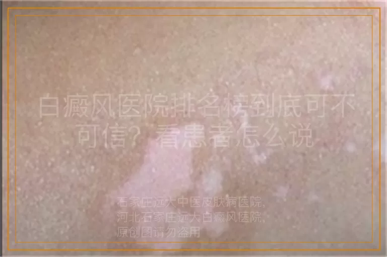 白癜风医院排名榜到底可不可信？看患者怎么说