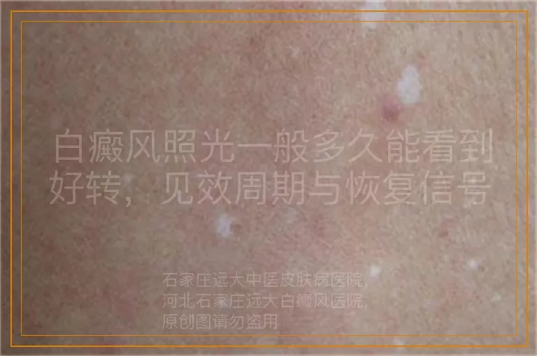 白癜风照光一般多久能看到好转，见效周期与恢复信号