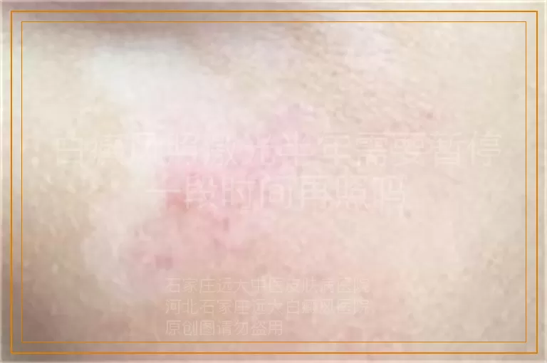 白癜风照激光半年需要暂停一段时间再照吗