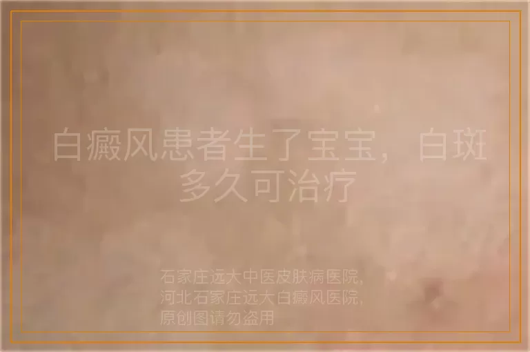 白癜风患者生了宝宝，白斑多久可治疗