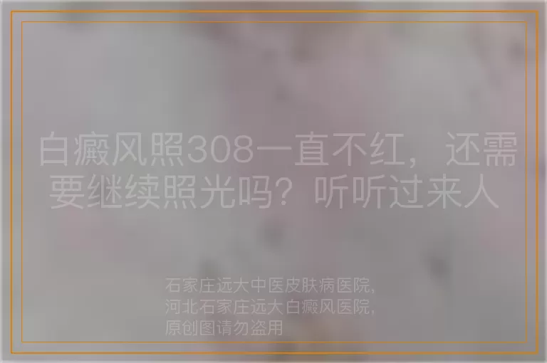 白癜风照308一直不红，还需要继续照光吗？听听过来人怎么说