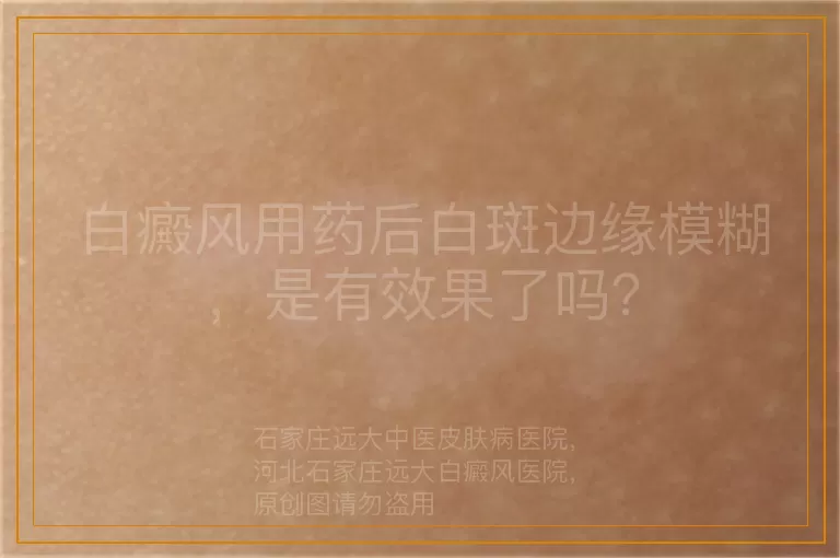 白癜风用药后白斑边缘模糊，是有效果了吗？