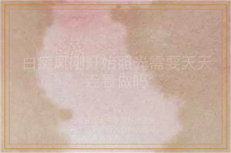 白癜风刚开始照光需要天天连着做吗