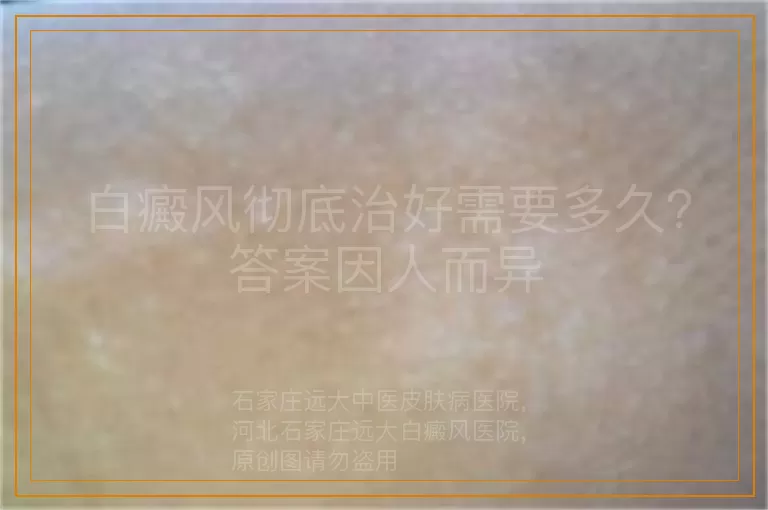 白癜风彻底治好需要多久？答案因人而异