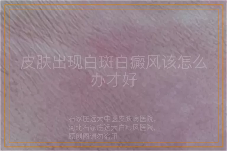 皮肤出现白斑白癜风该怎么办才好
