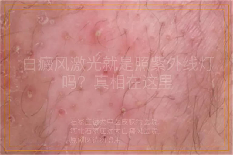 白癜风激光就是照紫外线灯吗？真相在这里